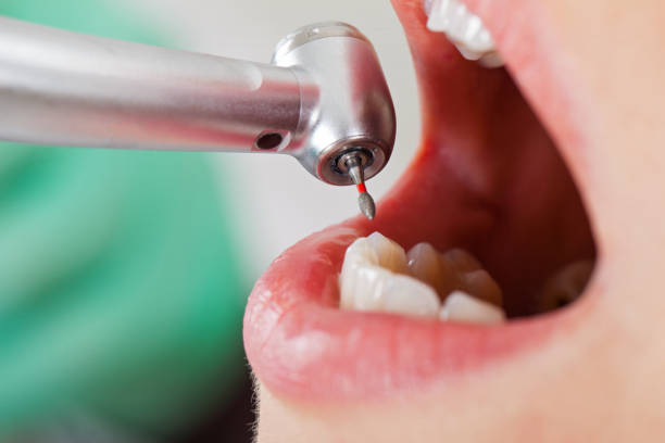 Best Emergency Tooth Extraction in Rossmoor, NJ